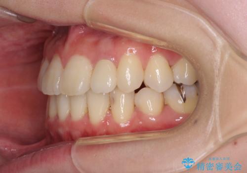 話しにくい歯並びの改善 抜歯矯正治療と前歯の審美治療の治療後