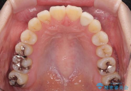 話しにくい歯並びの改善 抜歯矯正治療と前歯の審美治療の治療後