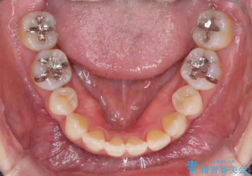 話しにくい歯並びの改善 抜歯矯正治療と前歯の審美治療の治療後