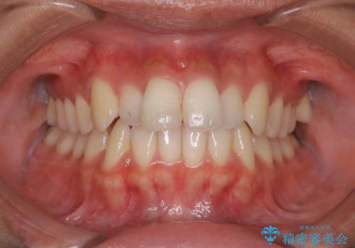 iTeroスキャン前のクリーニングの症例 治療前