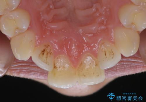 iTeroスキャン前のクリーニングの治療前