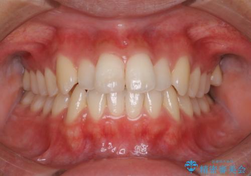 iTeroスキャン前のクリーニングの症例 治療後