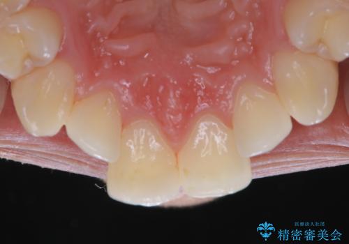 iTeroスキャン前のクリーニングの治療後