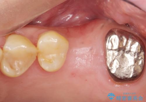奥歯のインプラント　ソケットリフト　60代男性の治療前