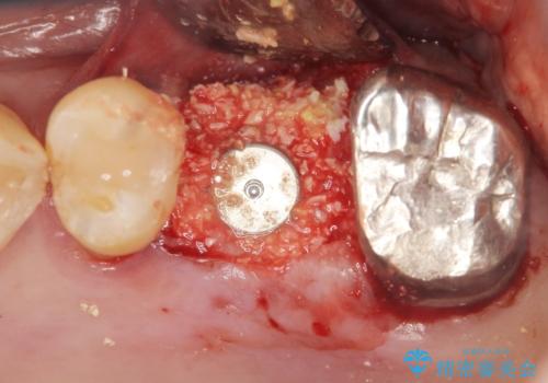 奥歯のインプラント　ソケットリフト　60代男性の治療中
