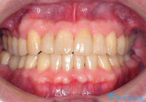 50代男性 受け口 他院で5年以上かかると治療を断られたの症例 治療後