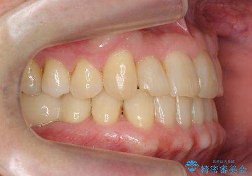 50代男性 受け口 他院で5年以上かかると治療を断られたの治療後