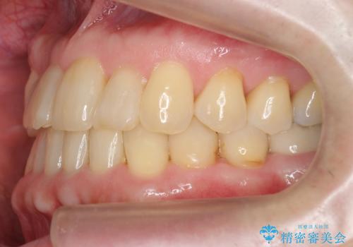 50代男性 受け口 他院で5年以上かかると治療を断られたの治療後