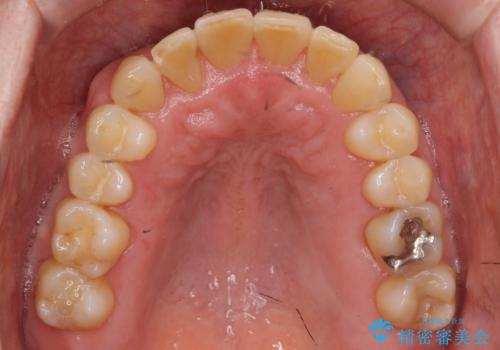 50代男性 受け口 他院で5年以上かかると治療を断られたの治療後