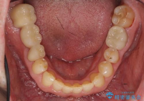 50代男性 受け口 他院で5年以上かかると治療を断られたの治療後