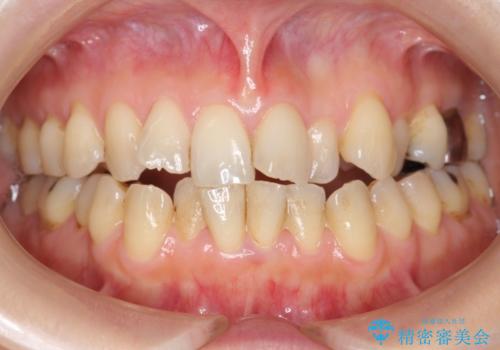 前歯のガタガタ　治療期間がかかっても良いので非抜歯でマウスピースでの症例 治療前