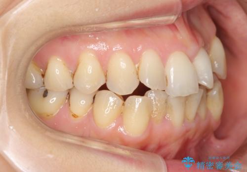 前歯のガタガタ　治療期間がかかっても良いので非抜歯でマウスピースでの治療前