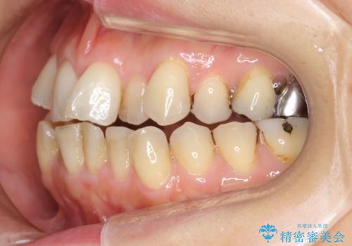 前歯のガタガタ 治療期間がかかっても良いので非抜歯でマウスピースでの治療前