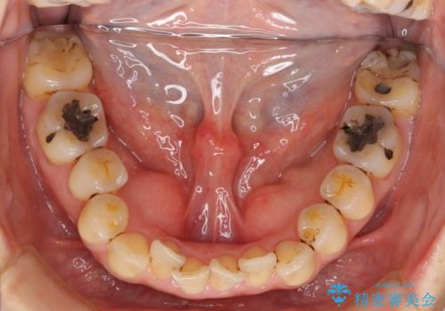 前歯のガタガタ 治療期間がかかっても良いので非抜歯でマウスピースでの治療前