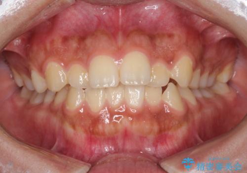 インビザライン　前歯のがたつきを目立たず矯正の症例 治療前