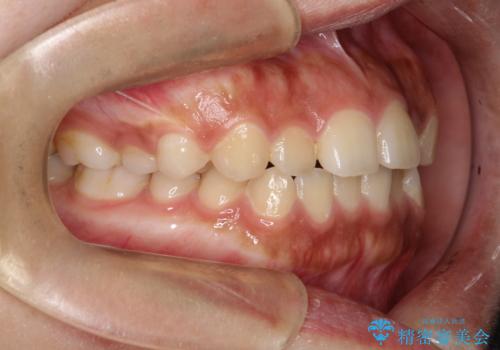 インビザライン　前歯のがたつきを目立たず矯正の治療前