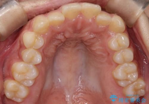 インビザライン 前歯のがたつきを目立たず矯正の治療前
