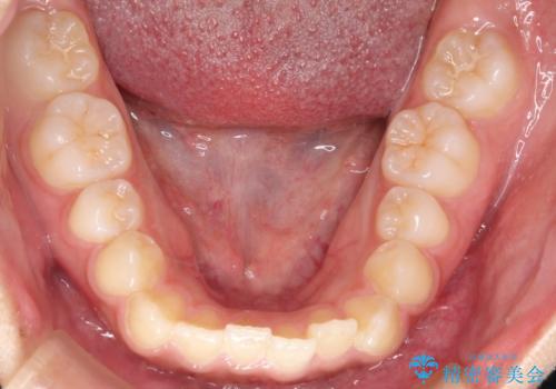 インビザライン 前歯のがたつきを目立たず矯正の治療前