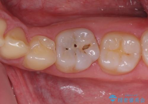 神経近くにまで及んだ大きなむし歯のセラミッククラウンの治療前