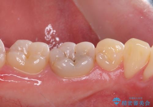 神経近くにまで及んだ大きなむし歯のセラミッククラウンの治療前