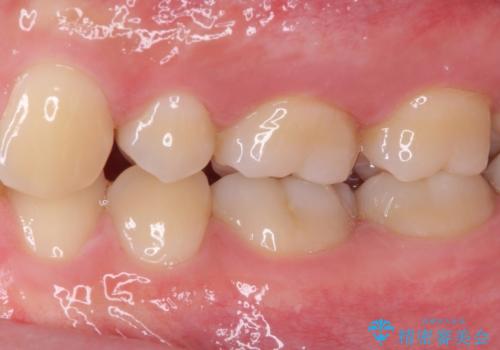 神経近くにまで及んだ大きなむし歯のセラミッククラウンの治療前