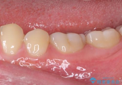 神経近くにまで及んだ大きなむし歯のセラミッククラウンの治療前