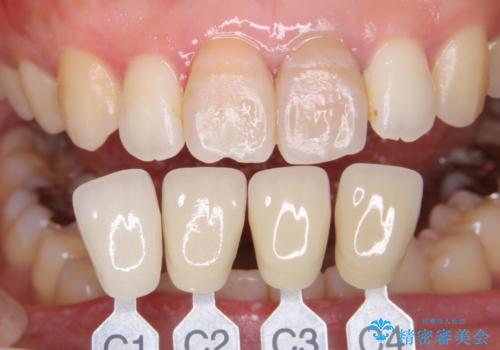 歯を白くしたい‐ウォーキングブリーチで内側から白くの治療前