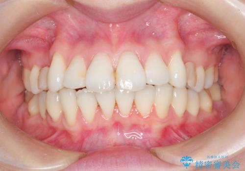 裏側のワイヤー矯正 抜歯して前歯をしっかり後ろに下げるの治療中