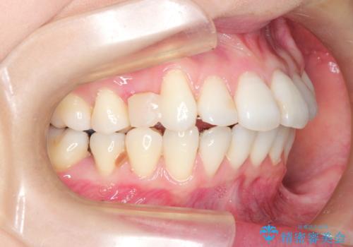 裏側のワイヤー矯正 抜歯して前歯をしっかり後ろに下げるの治療中