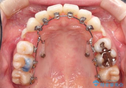 裏側のワイヤー矯正 抜歯して前歯をしっかり後ろに下げるの治療中