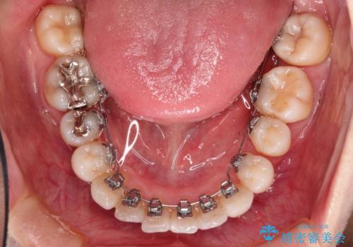 裏側のワイヤー矯正 抜歯して前歯をしっかり後ろに下げるの治療中