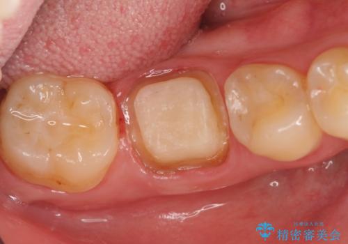オールセラミッククラウン 鈍い痛みが続く奥歯の治療の治療中