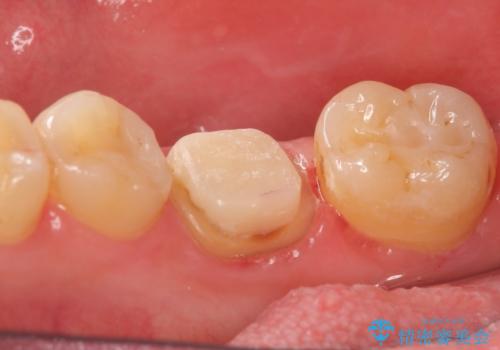 オールセラミッククラウン 鈍い痛みが続く奥歯の治療の治療中
