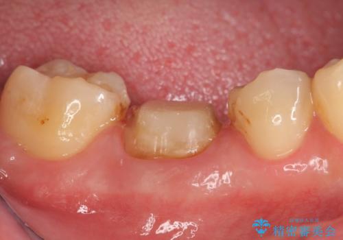 オールセラミッククラウン 鈍い痛みが続く奥歯の治療の治療中