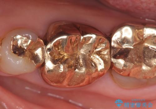 オールセラミッククラウン 他院にて抜歯と言われた歯の治療の症例 治療前