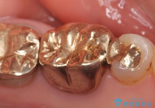 オールセラミッククラウン 他院にて抜歯と言われた歯の治療の治療前