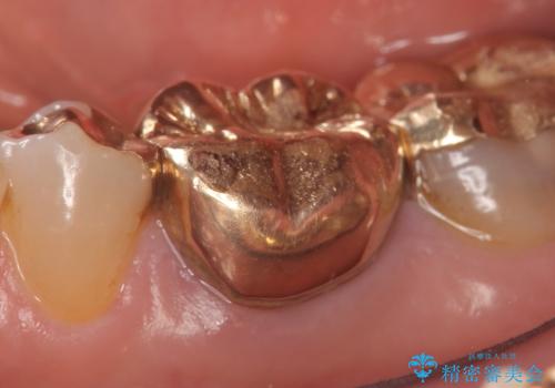 オールセラミッククラウン 他院にて抜歯と言われた歯の治療の治療前