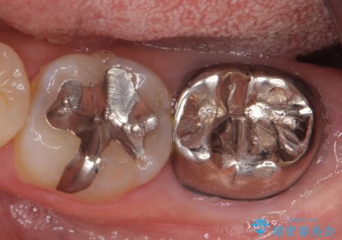 オールセラミッククラウン 咬むと痛む奥歯の治療の治療前