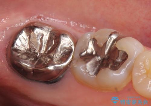 オールセラミッククラウン 咬むと痛む奥歯の治療の治療前