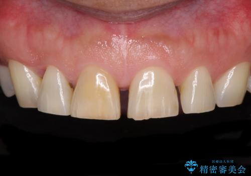 前歯の隙間を閉じたい　ラミネートベニアによる審美歯科治療の症例 治療前
