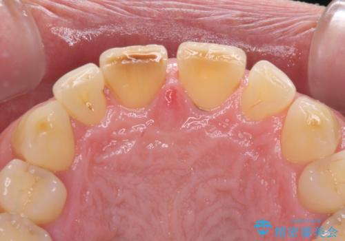 前歯の隙間を閉じたい　ラミネートベニアによる審美歯科治療の治療前