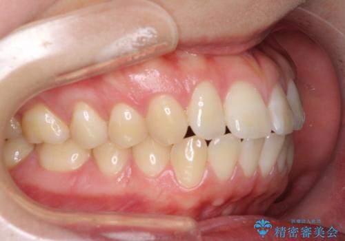 [口ゴボ] 口元が出ているのが気になる　ワイヤーによる抜歯矯正で口元をすっきりとの症例 治療前