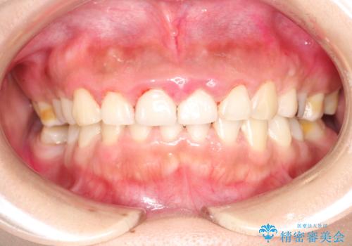 矯正治療を考えている方のクリーニングの治療後