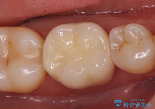 オールセラミッククラウン　目立つ銀歯を白い歯への症例 治療後