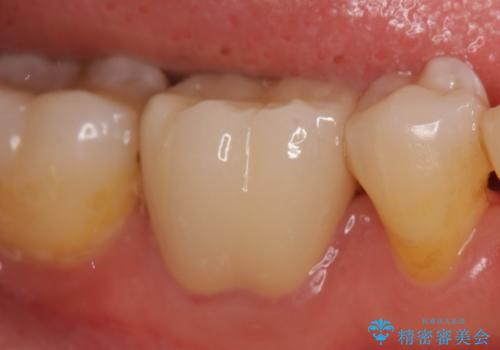 オールセラミッククラウン 目立つ銀歯を白い歯への治療後