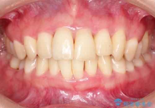 侵襲性歯周炎。前歯の歯周補綴の治療前