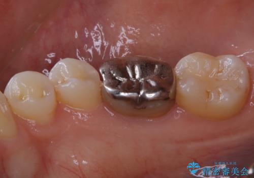 被せ物の下で進行してしまった虫歯の治療の治療前