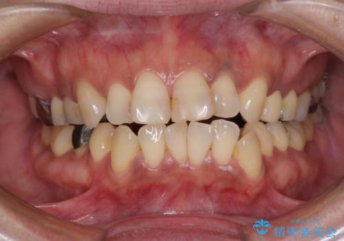 度重なる治療で前歯がしみる オールセラミッククラウンによる補綴治療の治療前