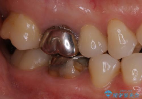 被せ物の下で進行してしまった虫歯の治療の治療前