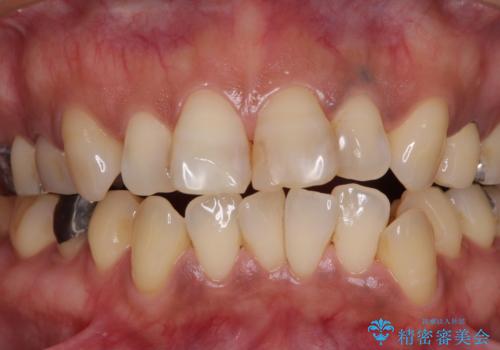 度重なる治療で前歯がしみる オールセラミッククラウンによる補綴治療の治療前